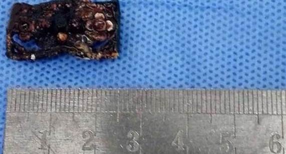 8岁女孩身体发出异味，X光结果令人惊叹，家长早干嘛去了？