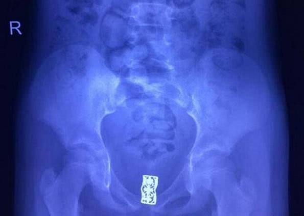 8岁女孩身体发出异味，X光结果令人惊叹，家长早干嘛去了？