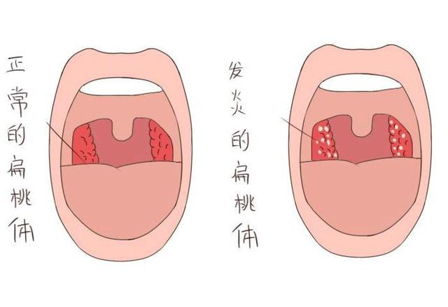 腺樣體肥大和扁桃體肥大的區別