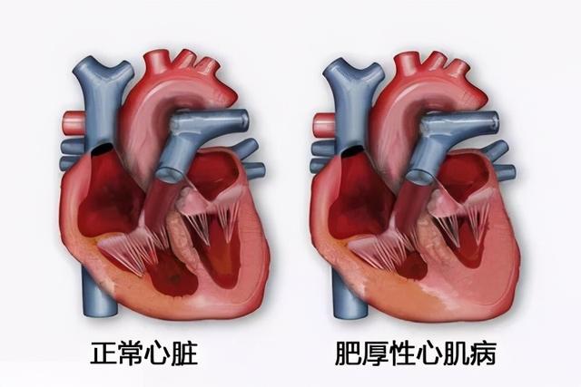 何,最近2年总感觉胸闷气短,到医院检查后,竟是得了梗阻型肥厚性心肌病