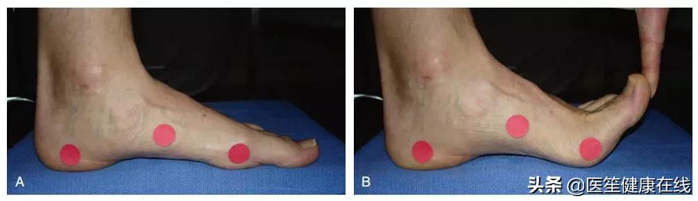 注:足部的绞盘机制:足趾背伸时,足弓升高