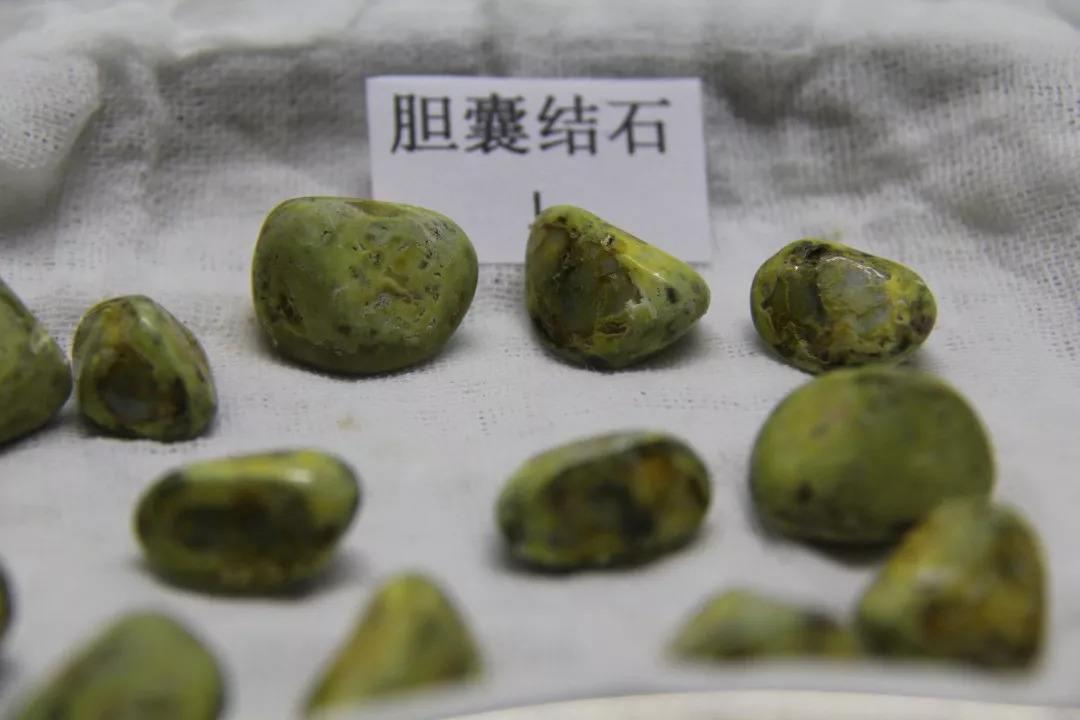 如何预防胆结石?最好的办法就是管住嘴,尽量清淡饮食