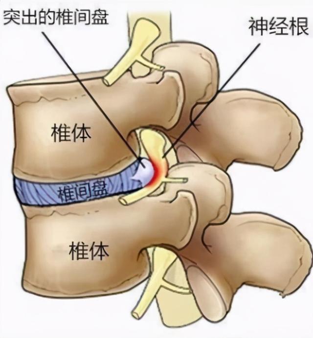 腰椎间盘突出症80%