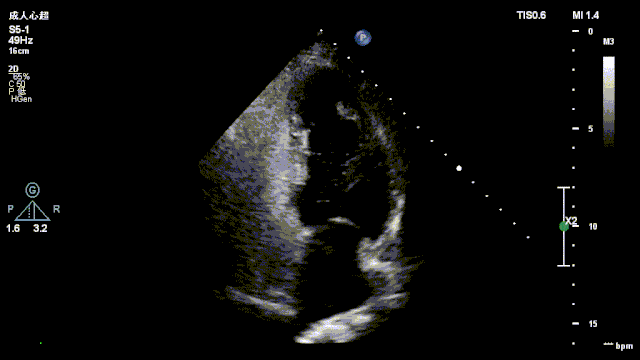 一例卵圆孔未闭患者声学造影图像