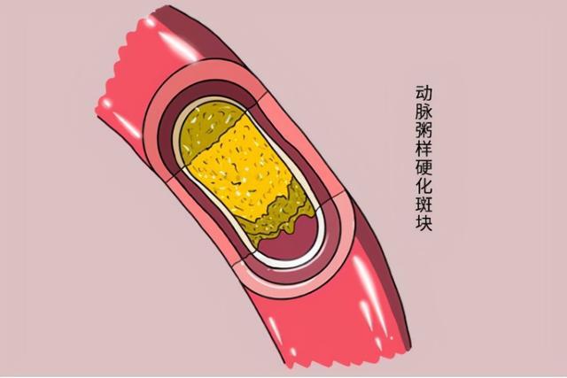 颈部淋巴结属于哪个科_颈部动脉斑块治疗属于哪科_颈部动脉有斑块怎么办