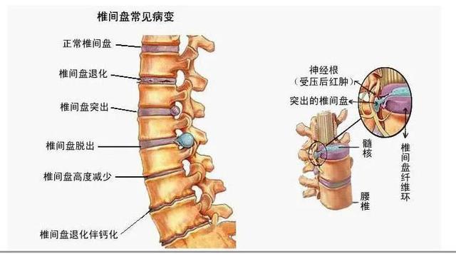 椎间盘突出示意图3D图片