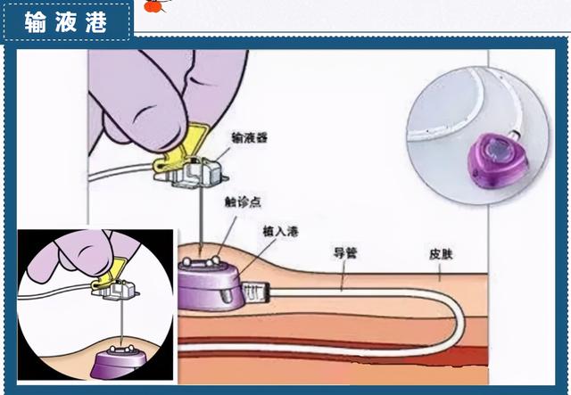输液港植入术手术步骤图片