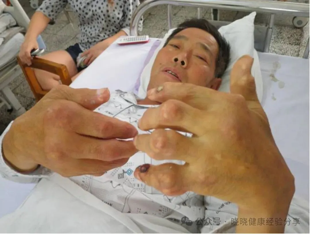 痛风是怎么一步步让人病倒的?强调:平日做好这3事,让痛风走远
