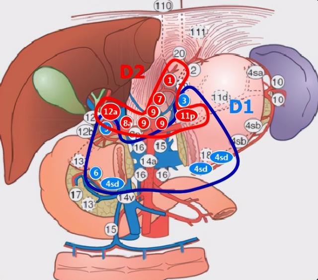 胃泌素瘤三角的示意图图片