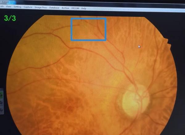 一觉醒来"瞎"了!眼睛也会"中风"