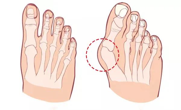 罗马脚也称为方形脚,这种脚的脚趾头差不多在一条水平线上,脚头较