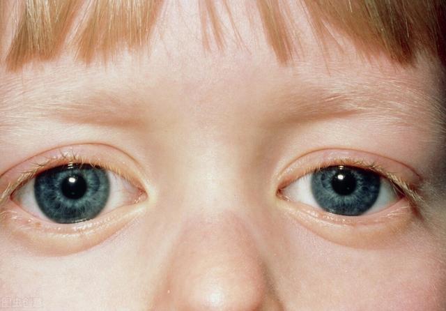 青光眼是怎么回事?给你分析它的4大诱因,了解清楚好预防