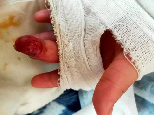 经手术治疗女孩手指逐渐恢复了血色