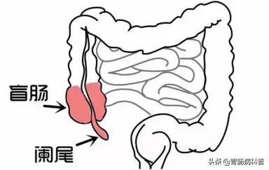 01单纯性阑尾炎