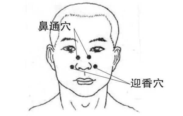 4 按穴位 按摩鼻部穴位能改善鼻炎发作期的鼻塞,流鼻涕,打喷嚏等