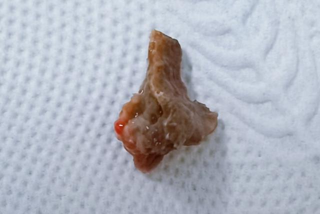 食管癌咳出的烂肉图片图片