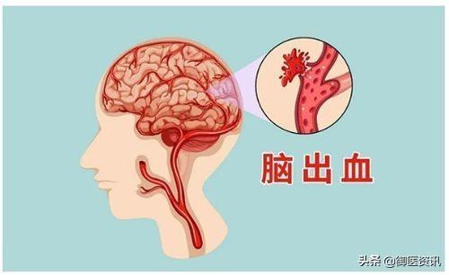 服用阿司匹林肠溶片,预防心脑血管疾病的发生,需要注意哪些方面