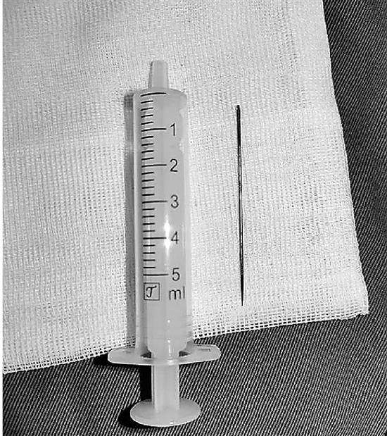 副主任医师和章捷主治医师通过膀胱镜手术,顺利将这枚缝衣针完整地从