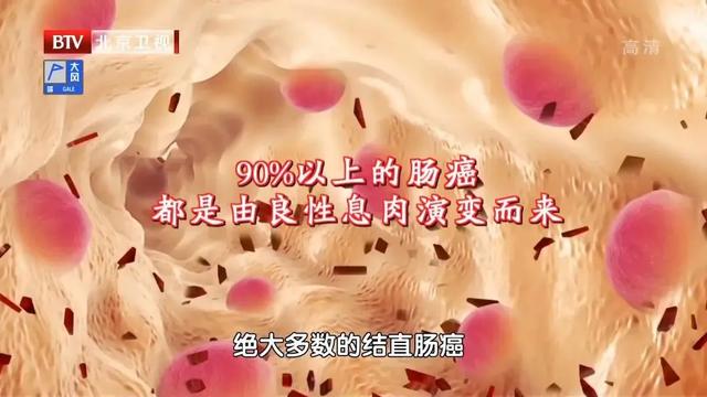 90%以上的腸癌都是由良性息肉演變而來!