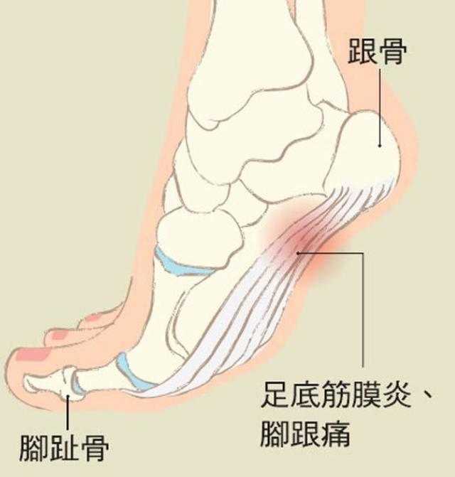 要警惕:跑完步后,导致的脚后跟儿疼